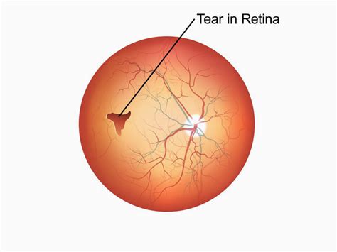 signs of a torn retina